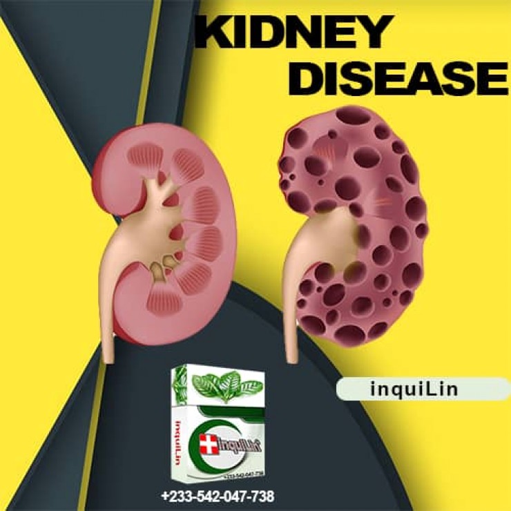 Best Medicine To Cure Kidney Stones Permanent in Ghana